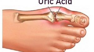Tratament natural pentru eliminarea acidului uric din articulaţii! Tratament pentru guta si articulatii!