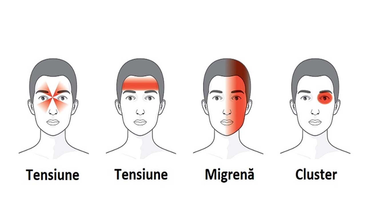 Ce ascund durerile de cap în funcție de zona afectată!