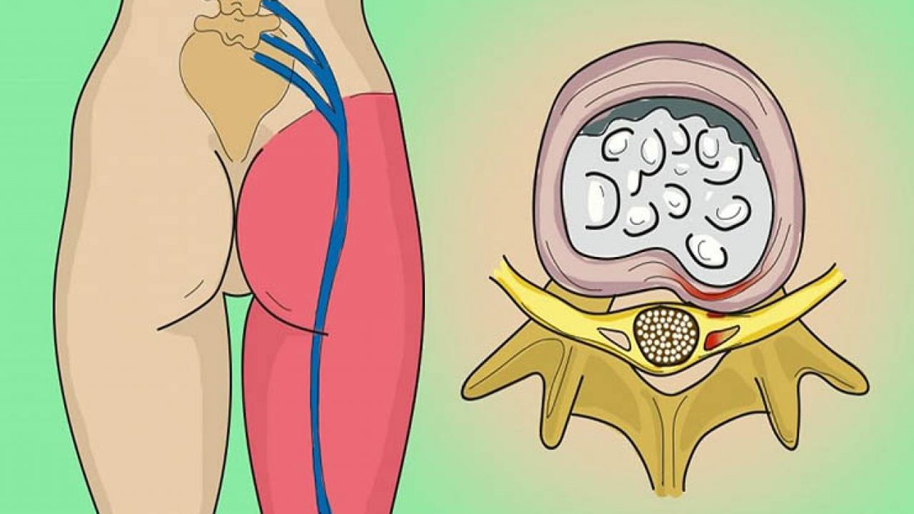 Remedii naturale pentru durerile cauzate de nervul sciatic