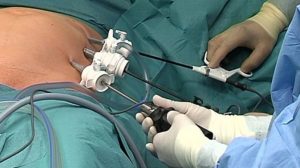 Hernia de disc se tratează în timp record, chiar in 20 de minute! Procedura medicală se realizează chiar în România, la Brașov