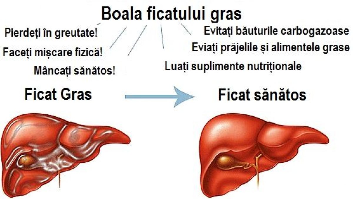 Simptomele ficatului gras și o rețetă eficientă pentru prevenirea acestei boli