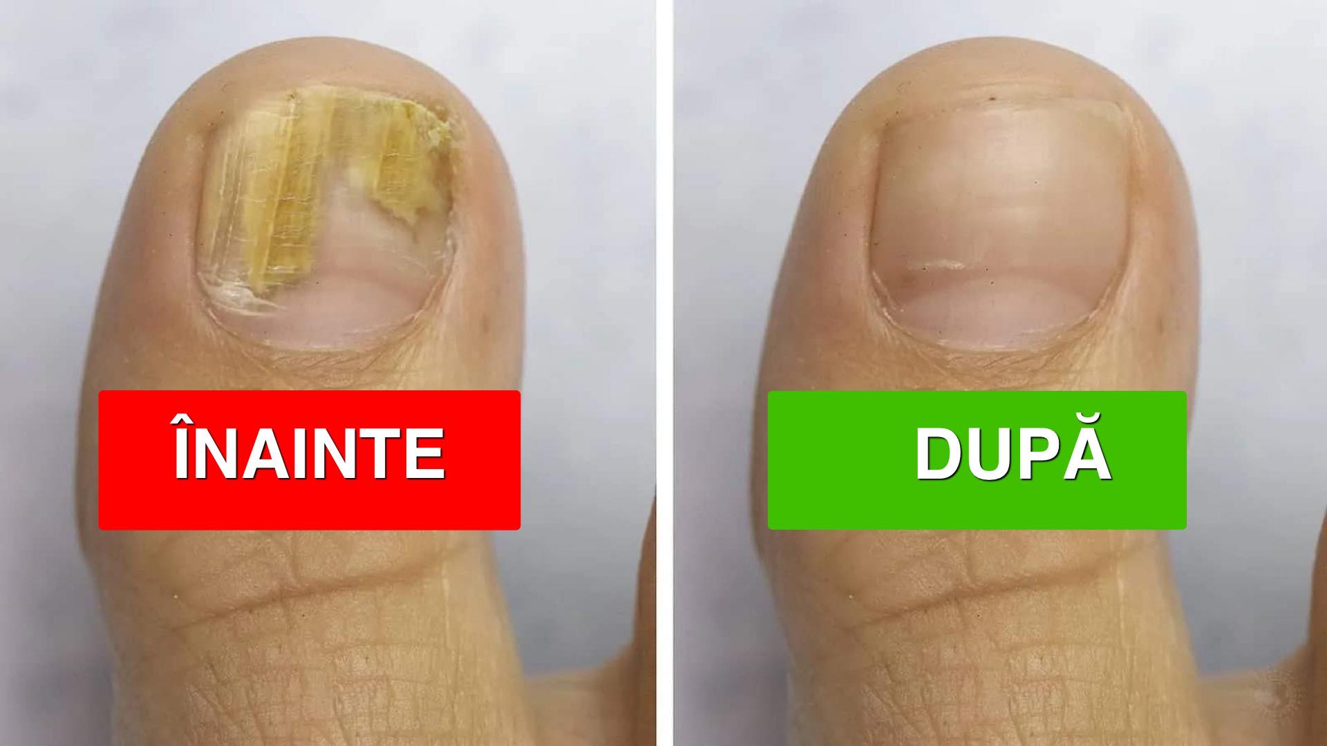 Dermatologii au explicat cauza ciupercii unghiilor (și cum să o remediezi)