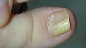 70% dintre români au probleme cu infecția unghiilor. Iată cum prepari un amestec natural care vindecă infecțiile unghiilor în doar câteva ore