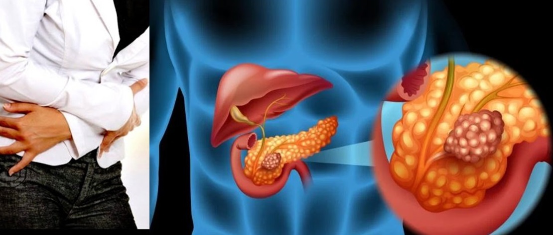 8 simptome și semne ale unui pancreas bolnav – Pancreasul, organul vital de care trebuie să avem mare grijă